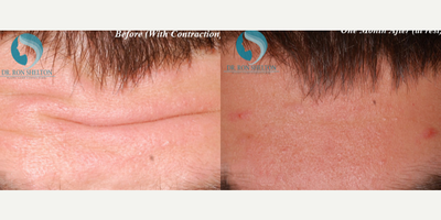 25-34 year old man treated with Fraxel Repair - Even with trying hard to contract his forehead he remains smooth after Botox.