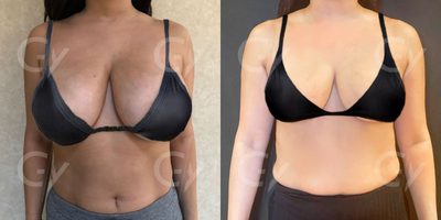 45-54 year old woman treated with Breast Lift - 45-54 year old woman treated with Breast Lift by M.D. Gray Yeiladal