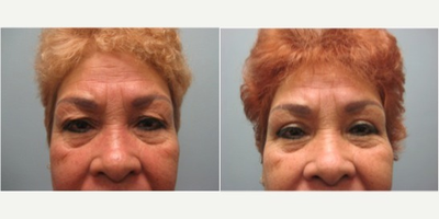 55-64 year old woman treated with Upper Eyelid Surgery - 58 year old woman treated with Upper Eyelid Surgery