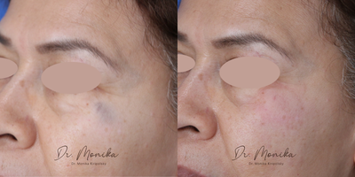 55-64 year old woman treated with Laser Resurfacing, Fractional Laser - For eight long years, this determined lady lived with asphalt embedded beneath her skin, seeking relief through numerous laser and chemical peel treatments in the past without success. Finally, she found us, and with our cutting-edge laser technology, she achieved INSTANT, transformative results. Her journey from persistent discomfort to remarkable recovery is a testament to the efficacy of our advanced treatments!