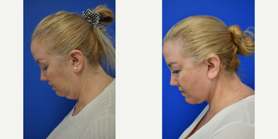 55-64 year old woman treated with Facelift, Chin Liposuction - She had no wrinkles but her full neck made her look a lot older than her 55 years! Dr Pautler did a lower face and neck lift on her and now she has a youthful jawline and younger appearance.