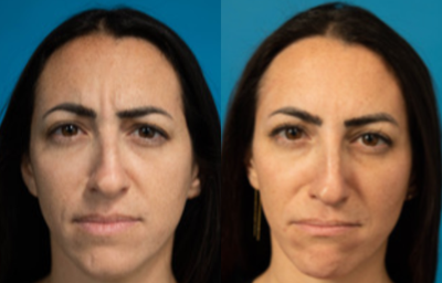 35-44 year old woman treated with Botox - Patient treated in Glabella area (Between Eyebrows)