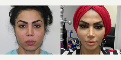 25-34 year old woman treated with Cheek Augmentation - 25-34 year old woman treated with Cheek Augmentation through facial fat transferas well as Buccal Fat Removal, Chin Implant, Lip Lift, and Brow Lift, shown 4 months post op.