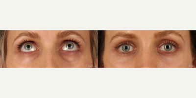 Scarless Lower Bleph (Eyelid Lift) with Fat Transfer and CO2 Laser Resurfacing - This beautiful 31-year-old female struggled with lower lid bags that were worsening with age. A transconjunctival (Scarless) lower lid blepharoplasty was performed to reduce the bags. Finesse multi-level fat transfer was performed to create mid-facial and lower lid contours. Fractional CO2 laser resurfacing was performed to tighten and rejuvenate the skin around the eyes.