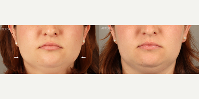 Masseter Botox (Non-Surgical Jawline Slimming) - 27-year-old female with a history of jaw grinding and clenching, facial pain and enlarged chewing muscles causing jaw widening. She is shown 6 weeks after neurotoxin (Botox) treatment to masseter muscles, resulting in jawline slimming and significant reduction in symptoms.