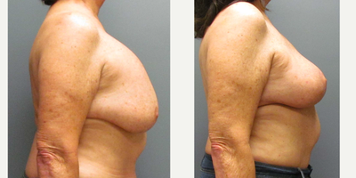 Breast Implant Removal, Capsulectomy, and Mastopexy Results for this 63-year-old Woman - Breast Implant Removal, Capsulectomy, and Mastopexy for this 63-year-old woman.
