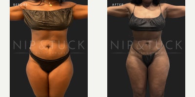 43 year old woman treated with Lipo 360 - 43 Years OldProcedure Taken:Lipo 3601 month Post-op