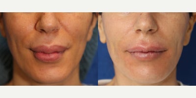 Foreign Body Lip Injection Removal After Illegal Permanent Filler Injections - Permanent lip fillers can become a serious problem when they cause pain, burning, and changes in the way the lips look and feel. Our patient is a 41-year-old White female who sought Dr. J. Timothy Katzen after having permanent filler placed illegally into both the upper and lower lips 20 years ago by an aesthetician in Germany. She had been told the product was a biopolymer. Years later, she began experiencing burning sensations in her lips and wanted the product removed before the problem worsened. Dr. Katzen recommended lip foreign-body injection removal to remove the permanent filler and the tissue affected by it. Under general anesthesia, he carefully opened the lips and removed the abnormal material from both the upper and lower lips. Lip foreign body removal is often needed when permanent fillers harden, irritate the tissue, or create an unnatural contour. Unlike temporary fillers, permanent products can remain in the lips for years and continue causing symptoms. The goal of surgery is to remove the foreign material, improve comfort, and help restore a more natural lip shape. These photos were taken 1 week after surgery and already show our patients remarkable result. Her case demonstrates Dr. Katzens expertise in lip filler removal surgery, permanent filler removal, and foreign body removal of the lips for symptomatic biopolymer injections. Early healing already suggests a softer texture, better contour, and improved comfort.