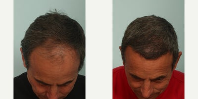 55-64 year old nonbinary person treated with Hair Transplant - 8 months post hair transplant.