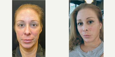 35-44 year old woman treated with Facelift, Deep Plane Facelift, Eyelid Surgery - 40 y.o female who had massive weight loss and underwent deep plane facelift, neckift and upper blepharoplasty.She was awake yet comfortable for the procedure
