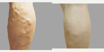 45-54 year old man treated with VenaSeal - Treatment for chronic venous insufficiency.