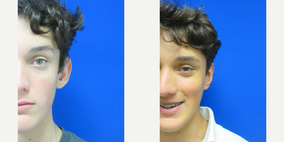Man treated with Ear Surgery - Dr. Schaffer performed Otoplasty (ear surgery) also known as ear pinning.