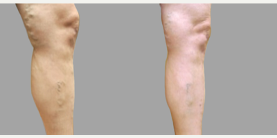35-44 year old woman treated with VenaSeal - Treatment for chronic venous insufficiency.