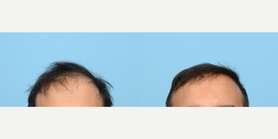 35-44 year old man treated with Hair Transplant, FUE Hair Transplant, Hair Loss Treatment, NeoGraft - This 44-year-old patient was experiencing thinning hair and a receding hairline. Dr. Wise performed an FUE hair transplant and implanted grafts to restore his hairline and add density to the crown. 6 months post-op the patient is thrilled with his results so far.  Full results will be visible at the 1 year mark.