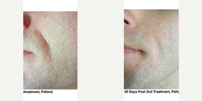 35-44 year old man treated with Pelleve - 35-44 year old man treated with Pelleve