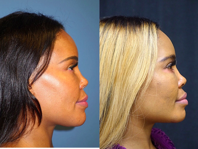 Chin Surgery - Chin Surgery