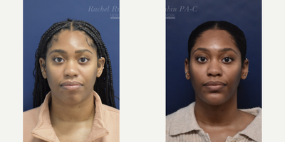 25-34 year old woman treated with Voluma, Restylane Lyft, Juvederm, Restylane, Restylane Defyne - A woman in her 30s after the injection of hyaluronic acid filler to the cheeks, under eyes, chin, and chin shadow. The goal is to improve facial balance. She also had a series of three EzGel PRF treatments to the under eyes.