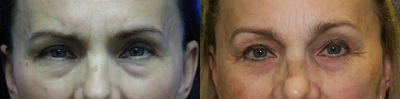 35-44 year old woman treated with Brow Lift - Endobrow lift with upper and lower blepharoplasty. Result after 2 months and after 17 years. Results after many years of facial rejuvenation surgeries hold up well despite sun damage. It is important to always wear sunscreen!