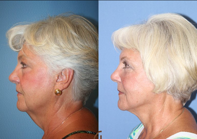 Neck lift - This patient wanted to improve her neck laxity. A neck lift was performed in our office with local anesthesia and twilight sedation without the need for general anesthesia.