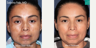 Woman treated with Clear and Brilliant - Woman treated with Clear and Brilliant