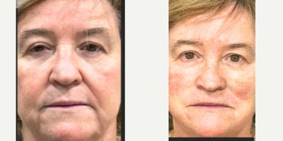50 year old woman treated with Thread Lift - 50 year old woman treated with Thread Lift