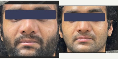 25-34 year man treated with Asian Rhinoplasty - 25-34 year old man treated with Asian Rhinoplasty.