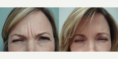 35-44 year old woman treated with Botox - This patient softened her Glabellar lines with Botox
