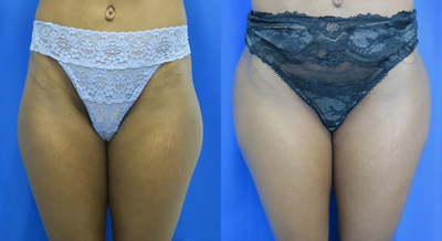 Woman treated with Hip Augmentation - Woman treated with Hip Augmentation using implants