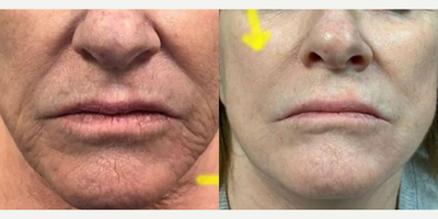Microneedling - By combing RF micro needling treatments with customized fillers treatments, we were able to reverse years of aging around the mouth and lower face.