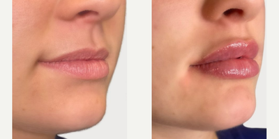 Dermal Fillers - Come get your perfect pout just in time for the holidays at Omni Aesthetics!