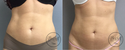 35-44 year old woman treated with UltraShape Power - Treatment protocols included 3 treatments of Velashape III. 3 Ultrashape Power were performed and final result shown 4 weeks after last treatment