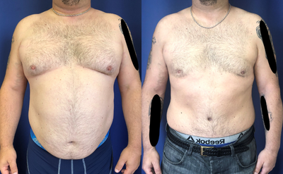 35-44 year old man treated with Male Tummy Tuck - A man in his 40s is shown 1 year after a short incision Tummy Tuck with Liposuction. A scar minimizing technique was employed, with the incision hidden in the underwear line. The goals of a male Tummy Tuck are different from a Tummy Tuck performed on a woman  instead of addressing female curves, the goal is a firmer, flatter abdomen in a man. A man may have excess skin after significant weight loss that needs to be smoothed, or abdominal muscles that need to be tightened after being separated or stretched during excessive weight gain.