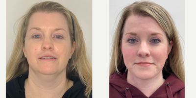 46 year old woman treated with Smart Lipo - 46 year old woman treated with Facelift, Neck Lift, and Smart Lipo.