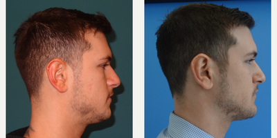 18-24 year old man treated with Chin Liposuction - The patient desired a more contoured neck, jaw line and chin projection. He was unhappy with the contour irregularities from his jaw line to chin and the fat pocket in his central neck. He underwent neck and jaw line liposuction for contouring and placement of a 5mm extended medpore chin implant. The implant was contoured on table and notice how his transition (where the bare patch of skin is) is smooth.