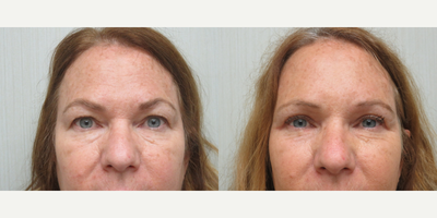 45-54 year old woman treated with Brow Lift, Eyelid Surgery - This patient underwent an endoscopic browlift and an upper lid blepharoplasty to soften the heaviness of her brow.