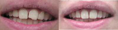 Filling to Repair Broken Tooth - 
	The patient's broken tooth was repaired with a filling.
