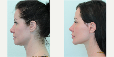 40+ year old woman treated with Facelift and Chin Augmentation - This young and active woman presented with the concern of sagging skin and fat under her chin, along with loss of definition of her jawline. She also did not prefer the strength of her nose in relation to her chin size. We decided together to perform a lower facelift and necklift, along with placing an Implantech extended anatomic silicone implant. She was given xanax before her procedure to relieve anxiety, and her procedure was completely performed under local anesthesia (with lidocaine) in our office. Procedure time was under 2 1/2 hours.She was able to return to the gym 10 days after her procedure after all sutures were removed.Her results demonstrate a well defined jawline with elimination of the sagging tissue previously under her chin. Her nose and chin are in better balance maintaining a natural appearance.