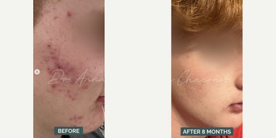 Woman treated with Accutane - Accutane is often seen as a last resort for severe acne, but did you know it does more than just clear your skin?Accutane actually shrinks oil glands, reducing oil production by up to 90%!