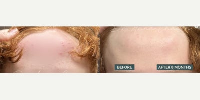 Woman treated with Accutane - Accutane is often seen as a last resort for severe acne, but did you know it does more than just clear your skin?Accutane actually shrinks oil glands, reducing oil production by up to 90%!