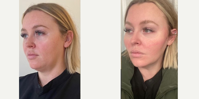 25-34 year old woman treated with Thread Lift - Patient treated with threads in cheeks to lift jawline and create more definition. These photos are before procedure and one day after procedure.