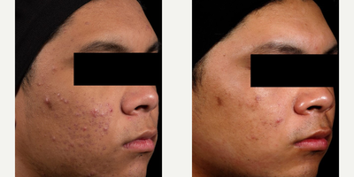 Man treated with AviClear - Man treated with AviClear