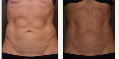 58 year old woman treated with Profound RF to tighten abdominal skin - 58 year old woman treated with both Profound Dermal and Profound SubQ for skin tightening on the abdomen