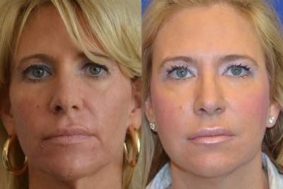 Injectable Fillers - Patient came in inquiring about alternatives to dermal filler for facial rejuvenation. After consulting with Dr. Ho, the patient elected to have a series of Sculptra treatments.