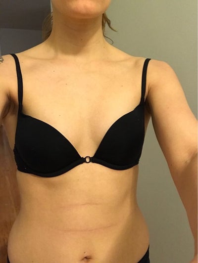 Breast Augmentation: A to C