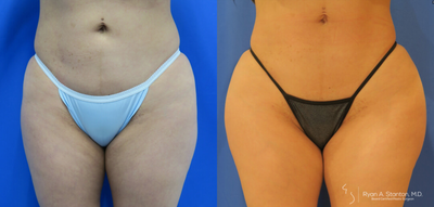 Woman treated with Hip Augmentation - Woman treated with Hip Augmentation using implants
