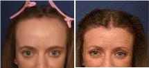 Woman treated with Hair Transplant - Woman treated with Hair Transplant for hairline lowering