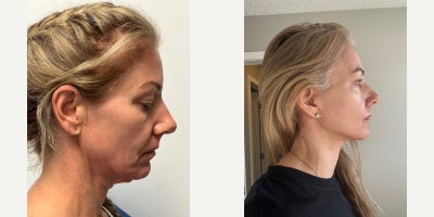 45-54 year old woman treated with Facelift - Face and Neck LiftAnterior PlatysmaplastyTemporal liftingBlepharoplasty