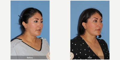 47 year old woman treated with Deep Plane Facelift, Neck Lift, Brow Lift, Buccal Fat Removal, MACS Facelift - 47 year old woman treated with Deep Plane Face and Neck Lift, Temporal Brow Lift, Buccal Fat Extraction, MAC