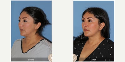 47 year old woman treated with Deep Plane Facelift, Neck Lift, Brow Lift, Buccal Fat Removal, MACS Facelift - 47 year old woman treated with Deep Plane Face and Neck Lift, Temporal Brow Lift, Buccal Fat Extraction, MAC