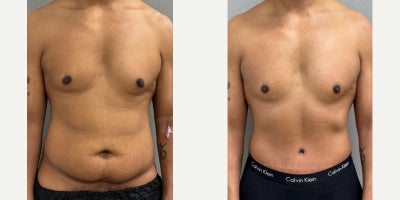 35-44 year old man treated with Male Tummy Tuck - 38 yo male s/p tummy tuck performed in our on site AAAA certified operating suite.